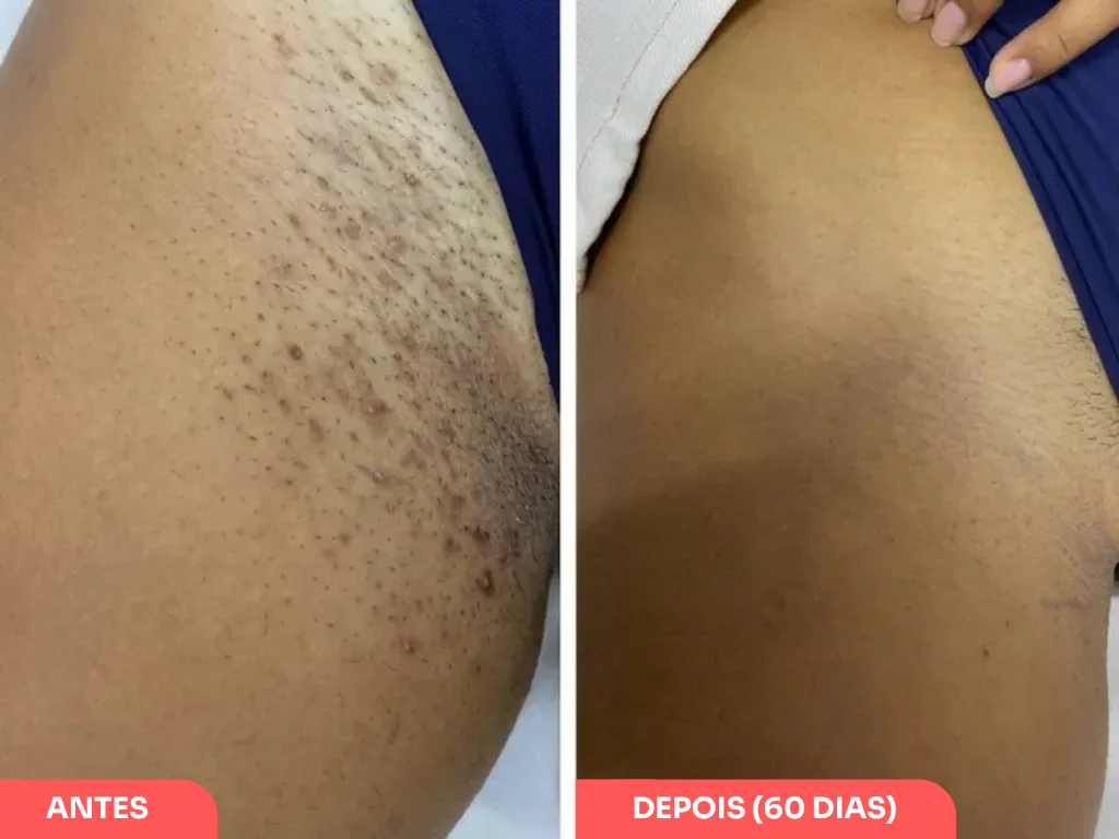 Antes e depois: pele com foliculite comparada à pele lisa após 60 dias de tratamento